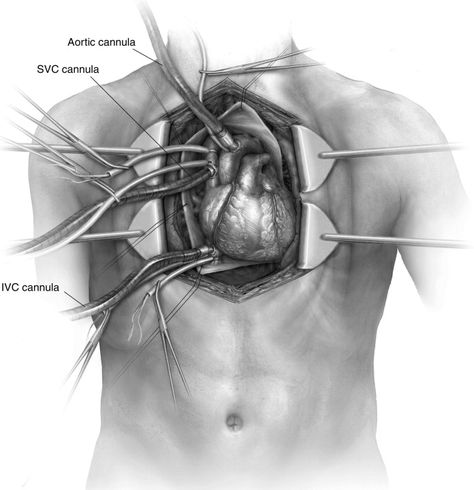 Cardiac Autotransplantation - Operative Techniques in Thoracic and Cardiovascular Surgery Thoracic Surgery, Cardiovascular Surgeon Aesthetic, Cardio Thoracic Surgery Aesthetic, Surgery Art, Cardiac Surgeon, Cardiothoracic Surgeon, Cardiac Tamponade, Heart Facts, Cardiac Perfusion Technology