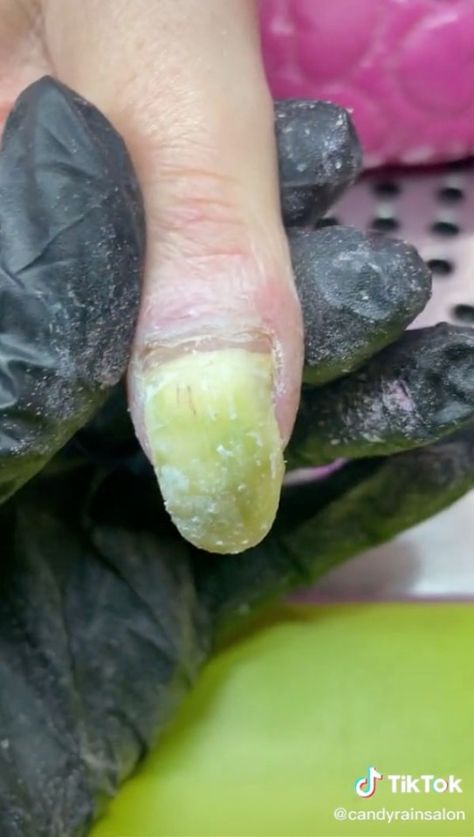 A NAIL technician shared a video of her client’s severely damaged nails – they’ve turned green, they’re lifting off, and she’s had to cut one of them right back to the cuticle. Candy Rain Salon, based in Plymouth, shared the video, which showed the effects of repeatedly getting acrylic applied over damaged nails. Nail tech […] Damaged Nails After Acrylics, Nail Fails, Remove Fake Nails, Nail Disorders, Nails After Acrylics, Candy Rain, Cracked Nails, Fail Nails, Bad Nails