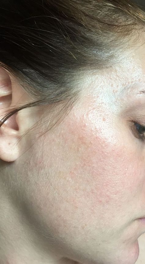 Small rash like bumps all over face - Beauty Insider Community Heat Rash On Face, Skin Rash On Face, Face Rash Remedies, Skin Rash Remedies, Skin Rashes Pictures, Face Rash, European Skincare, Small Bumps On Face, Rash On Face