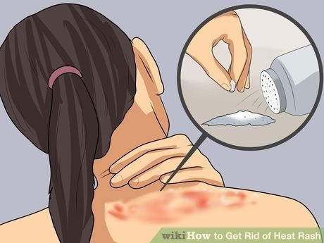 Heat Rash On Face, Treating Heat Rash, Heat Bumps, Heat Rash Remedy, Prickly Heat Rash, Home Remedies For Rashes, Allergy Rash, Body Rash, Rash On Face