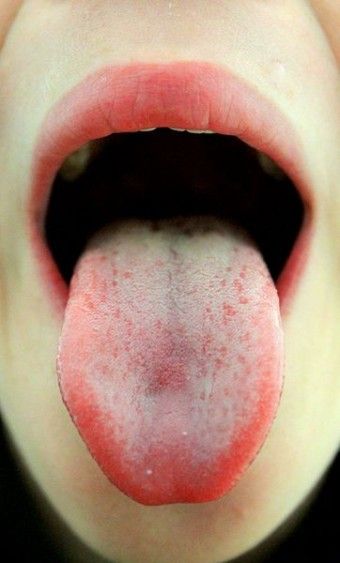 Supertaster? How to tell...more or less scientifically. Tongue Painting, Burning Tongue, Tongue Out, Remedies For Dry Mouth, White Tongue, Tongue Health, Dry Mouth, Oral Care Routine, Average Person