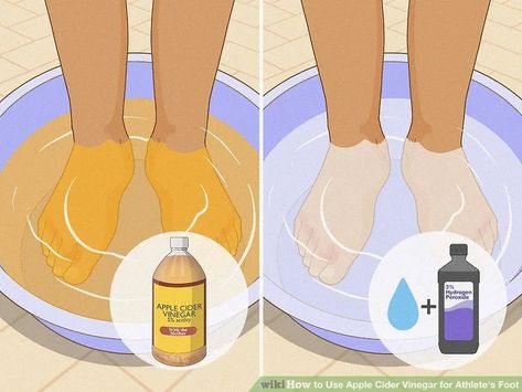 4 Ways to Use Apple Cider Vinegar for Athlete's Foot - wikiHow Apple Cider Vinegar Feet Soak, How To Make Your Feet Not Stink, How To Get Rid Of Athletes Foot Fast, Athletes Foot Remedy How To Get Rid Of, Athletes Foot Remedy, Smelly Feet Remedies, Foot Fungus Remedies, Apple Cider Vinegar Foot Soak, Apple Cider Vinager