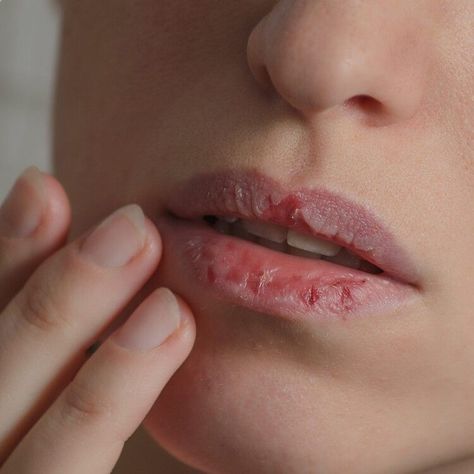 Best Cough Remedy, Eyeshadow Styles, Eyeliner Techniques, Dry Cracked Lips, Embrace Natural Beauty, Makeup Brushes Guide, Best Lip Balm, Flawless Makeup Application, Cracked Lips