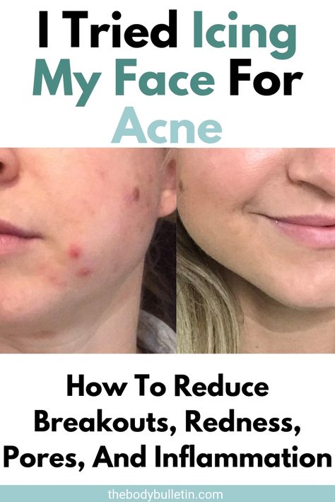 Acne Inflammation Remedies, Does Ice Help Pimples, Face Redness Remedy Diy, Is Ice Good For Your Face, Ice For Acne, Reduce Redness In Face Acne, Breakouts On Face Remedies, Face Inflammation Remedies, Ice Therapy Face