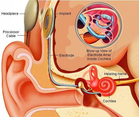 Cochlear Implant | Conditions & Treatments | UCSF Benioff Children's Hospital Auditory Verbal Therapy, Ear Anatomy, Cochlear Implants, Deaf Awareness, Deaf Education, Slp Resources, Cochlear Implant, Deaf Culture, Medical Anatomy