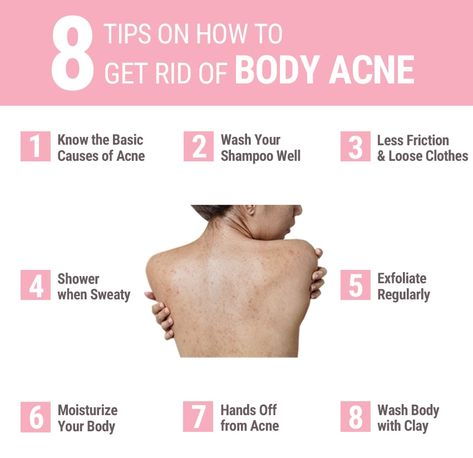 Chest And Back Acne Remedies, How To Clear Back Acne Fast, Tips For Back Acne, How To Remove Back Acne, Back Acne Scar Removal, How To Treat Back Acne, How To Get Rid Of Chest Acne, How To Clear Back Acne, Body Acne How To Get Rid Of