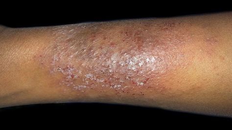 Dry skin patches: Causes, symptoms, diagnosis, and treatments Scale Skin, Scaly Skin, Skin Patches, Dry Skin Patches, Red Patch, Cracked Skin, Peeling Skin, Skin Disorders, Flaky Skin