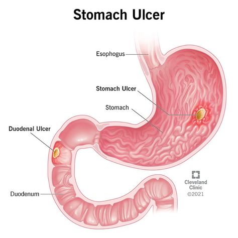 Ulcer Symptoms Signs, Peptic Ulcers Symptoms, Stomach Ulcers Symptoms Remedies, Ulcers In Stomach Remedies, Heal Stomach, Stomach Ulcers Symptoms, Ulcer Symptoms, Ulcer Diet, Gastric Problem