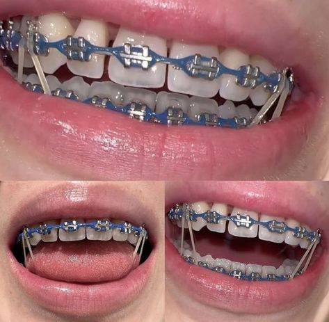 Midnight Glow Braces, Braces Chain Colors, Color Of Braces Ideas, Silver Power Chain Braces, Braces Colors For Latinas, Teeth Braces Colors, Power Chain Braces Colors Ideas, Power Chain Braces Colors, Braces With Gap Teeth