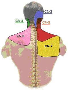 cervical facet referral pattern. Im getting 2 shots in my cervical spine facets to hopefully help get better. :) Punkty Spustowe, Spine Problems, Headache Causes, Forward Head Posture, Body Pain, Nerve Pain, Shoulder Pain, Reflexology, Neck Pain