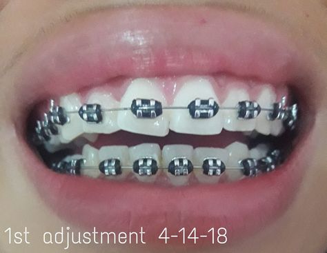 braces health aesthetic brace bracing braces cost braces for teeth bracee teeth braces teeth bracers teeth braces colors braces near me braces for straight teeth braces for teeths braces on teeth braces aesthetic brace color ideas braces colors ideas cute healthy recipes healthy cooking healthy supers healthy cook recipes healthy and delicious healthy food healthy lifestyle healthy snack healthy eats teeth whitener teeth jewelry teeth whitening with braces teeth smile teeth gems teeth color Braces With Black Bands, Braces Black Bands, Black Braces Color, Black Braces Power Chain, Color For Braces, Black Braces Teeth, Black Braces Bands, Braces Colors Ideas Cute, Light Blue Braces