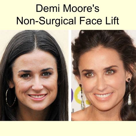 Demi Moore has been using loads of fillers and botox for a more natural looking non-surgical face lift. The above pictures are from 2007 on the left and June 2011 on the right. AMAZING results you can get yourself! Whatever Demi is doing, she is doing it RIGHT! http://alteredidentity.com/demi-moores-non-surgical-face-l…/ | #celebrity #demimoore #beauty #hollywood #style #glamour #skin #cosmetic #facelift #newyork #fillers #young #botox #juvederm #radiesse #restylane #hydrafacial #dermapen #meso… Derma Pen, Hydra Facial, Facial Aesthetics, Hollywood Style, Demi Moore, Julianne Moore, Cosmetic Procedures, Face Lift, Room Interior