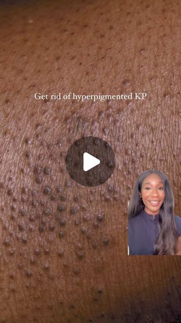 Dr Kemi Fabusiwa on Instagram: "Hyperpigmented Keratosis Pilaris giving you the bumps? Don’t worry, I’ve got you covered! Get smoother skin with this routine that I absolutely swear by: ✨

🧼 In the shower, start by using a salicylic acid body wash with a shower mitt - it’s like a deep cleanse for your pores!
✨ Next, apply a glycolic acid balm to break down those keratin plugs. It’s like a magic eraser for your skin, darling! Plus, it’s enriched with shea butter for extra nourishment.
💦 A quick spritz of a fast-absorbing spray adds that extra layer of moisture we all need.
🌙 Before bed, pamper your skin with a retinoid-like body oil. It’s like retinol but gentler, and it’s also fantastic for tackling hyperpigmentation caused by KP! 👑" Body Wash For Hyperpigmentation, Salicylic Acid Cleanser, Glycolic Acid Toner, Keratosis Pilaris, Body Serum, Moisturizing Serum, Smoother Skin, Glass Skin, Glycolic Acid