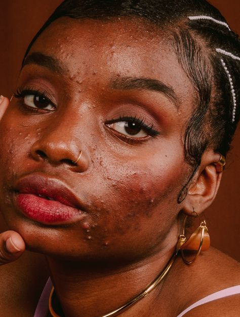 A New Study Reveals The Mental & Professional Scars Adult Acne Can Have On Women #refinery29 https://www.refinery29.com/en-au/mental-health-toll-adult-acne-women Acne Dark Skin, Embracing Acne, Acne Black Women, Acne Photoshoot, Acne Photography, Acne Model, Women With Acne, Acne Aesthetic, Acne Photos