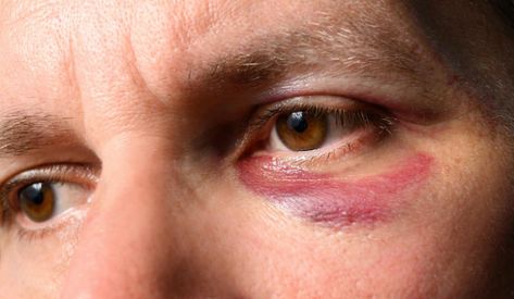 7 BEST HOME REMEDIES FOR BLACK EYES We refer to an eye bruise as a black eye. When blood collects behind the skin around the eyes, it occurs. Black eyes typically form after a head or face injury, however, they can also appear following facial surgery. https://elnodiacademy.com/black-eye/ Face Injury Drawing Reference, Face Bruising, Bruising Makeup, Face Injuries, Toby Mcguire, Micah Bell, Overnight Remedies, Wound Makeup, Eye Injury