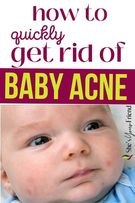 A baby with acne and text overlay that reads how to quickly get rid of baby acne Newborn Rash On Face, Baby Acne Remedy How To Get Rid Of, Baby Acne Remedy Breastmilk, Baby Dry Scalp, Face Rash Remedies, Newborn Dry Skin, Newborn Rash, Baby Acne Remedy, Skin Rash Remedies