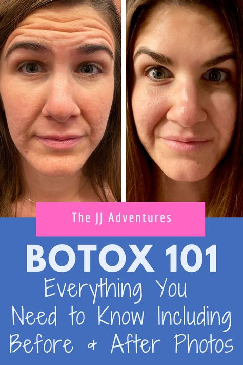 After Botox Care, Botox For Beginners, Xeomin Before And After, Botox 11 Lines Before After, Botox Timeline, Before And After Botox Pictures, Botox After Care, Botox Before After, Before After Skincare