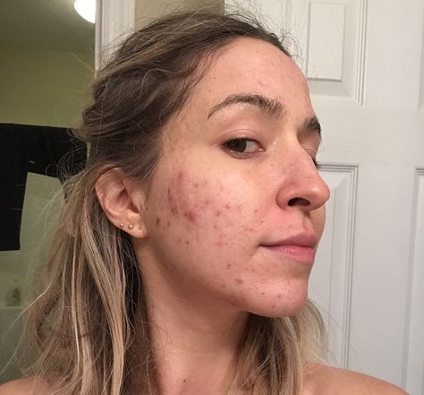 The Secret that Cleared My Severe, Hormonal, Cystic, Itchy, Adult Acne after 17 Years – Part 2 – Brooke's Beauty Bazaar Hormonal Acne Recipes, Cystic Hormonal Acne, Clear Chin Acne, Cystic Acne Routine, Hormonal Acne Routine, Healing Hormonal Acne, Natural Hormonal Acne Remedies, Herbs For Hormonal Acne, Acne Diet Plan Hormonal