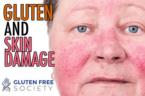 Can Gluten Cause Skin Problems? on Gluten-Free Society Gluten Allergy Rash, Allergy Rash, Gluten Intolerance Symptoms, Celiac Recipes, Zinc Deficiency, Gluten Allergy, Gluten Sensitivity, Gluten Intolerance, Skin Allergies