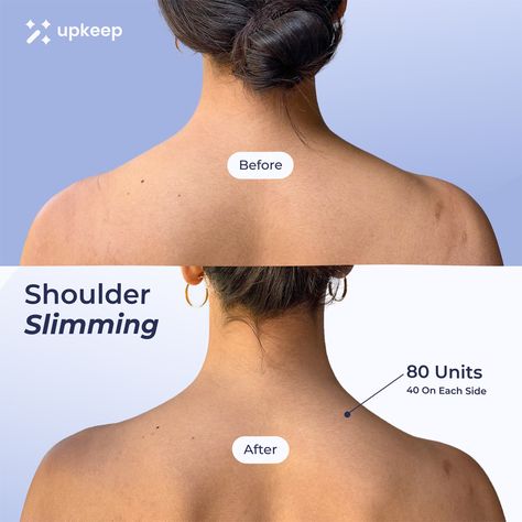 Slimmer shoulders with 80 units of Botox! 40 on each side for an elongated neck, corrected posture, and engaged abs! Book on Upkeep: your go-to app for effortlessly booking on-demand medical aesthetics treatments at trusted providers near you! Book at vetted MedSpa’s near you on the Upkeep app! Available on iOS & Google Play! # botox aesthetic Botox injections sites Botox before after Botox face Botox aesthetic Shoulder Botox Before And After, Barbie Botox Before And After, Skin Before And After, Neck Botox Before And After, Botox Before After, Slimmer Shoulders, Botox Aesthetic, Botox Injection Sites, Botox Before And After