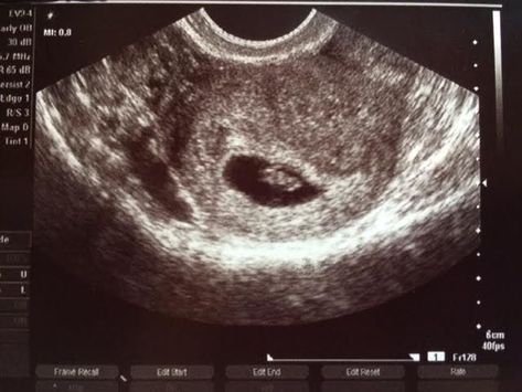 First Ultrasound, Baby Ultrasound, Ultrasound Tech, The Nose, Baby Gif, Inspirational Images, Ultrasound, Baby Fever