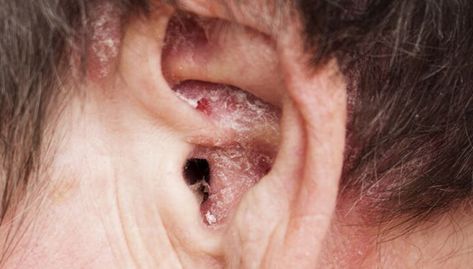 Itchy Ears Remedies, Proper Skin Care Routine, Ear Wax Buildup, Peroxide Uses, Hydrogen Peroxide Uses, Itchy Ears, Dry Skin Routine, Hearing Damage, Dry Skin Remedies