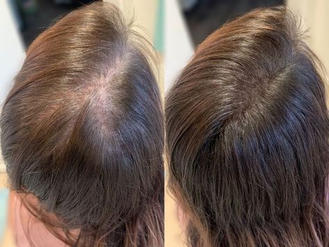 Alopecia Aesthetic, Hair Prp Before And After, Hair Before And After, Hair Botox Vs Keratin, Frontal Fibrosing Alopecia Hair Pieces, Hair Filler, Prp Hair, Best Human Hair Extensions, Before And After Hair