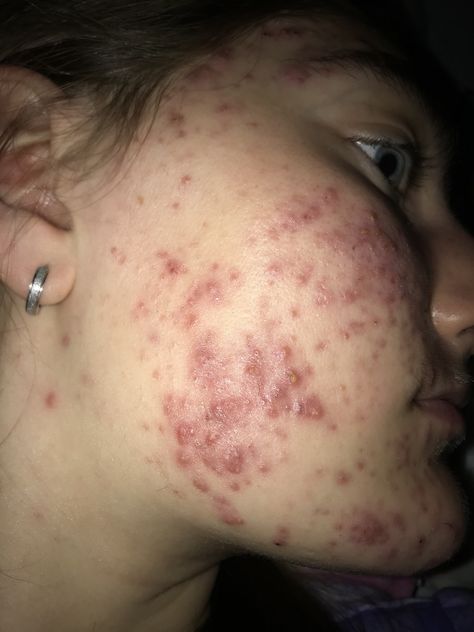 Really Bad Acne, Strawberry Freckles, Acne Positive, Acne Photos, Pimple Face, Acne Pictures, Skin Positivity, Massage Images, Get Rid Of Pimples