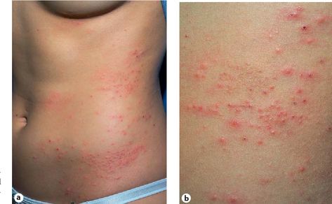 Progesterone Deficiency Remedies, Follicular Hyperkeratosis, Dermitis Herpetiformis, Itchy Skin Rash, Contact Dermitis Rash, Progesterone Cream, Oral Pathology, Follicular Phase, Epidermal Growth Factor