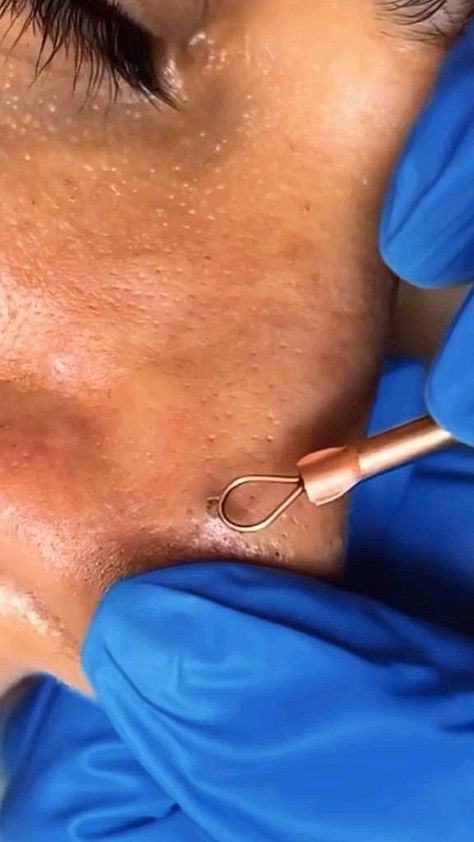 Satisfying Pimple Popping: A Guilty Pleasure! Satisfying Pimple Pops, Oddly Satisfying Videos Blackheads, Dr Pimple Poppìng Videos, Oddly Satisfying Videos Pimples, Leg Pimples, Cysts Popping Videos, Pimple Poppìng Videos Satisfying, Pimple Poppìng Videos, Satisfying Black Head Removal Video