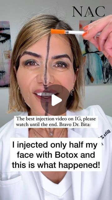 Erika Barry on Instagram: "Bravo @nacmedspa …. This is best injector/injection video on IG!!! 🎉🎉The importance of injecting your DAO PLUS your superficial plats….if you just inject your DAO, and your superficial plats recruit… your jowls will worsen. So consider injecting both plats and dao! - I’m speaking on this topic @modernbeautycon this 6/29!!!! - Make sure to follow @drbitafarrell @nacmedspa  👇🏻👇🏻👇🏻 Muscles of the face either pull up or pull down.  When the muscles that pull the lower face down (platysma and DAO) are injected and relaxed with a Neuromodulator such as Botox, the muscle that pulls the mid face up (zygomaticus or cheek muscle) dominates and pulls the face up!  This can help reduce the appearance of marionette lines, jowls, frown (rbf, or sad face), and the nasol Botox For Jaw Clenching, Botox For Frown Lines, Botox For Lower Face, Botox For Marionette Lines, Botox Marionette Lines, Botox Before After Jowls, Rbf Face Aesthetic, Dao Muscle Botox Before And After, Dao Botox Before After