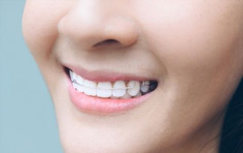 A permanent retainer is a type of wire that is permanently attached to the teeth after the braces are off. This is also known as the bonded retainer. It helps to maintain a brilliant alignment of your teeth. Permanent Retainer, Retainer Teeth, After Braces, Teeth Braces, The Teeth, Teeth Care, Dental Care, Braces, Need To Know