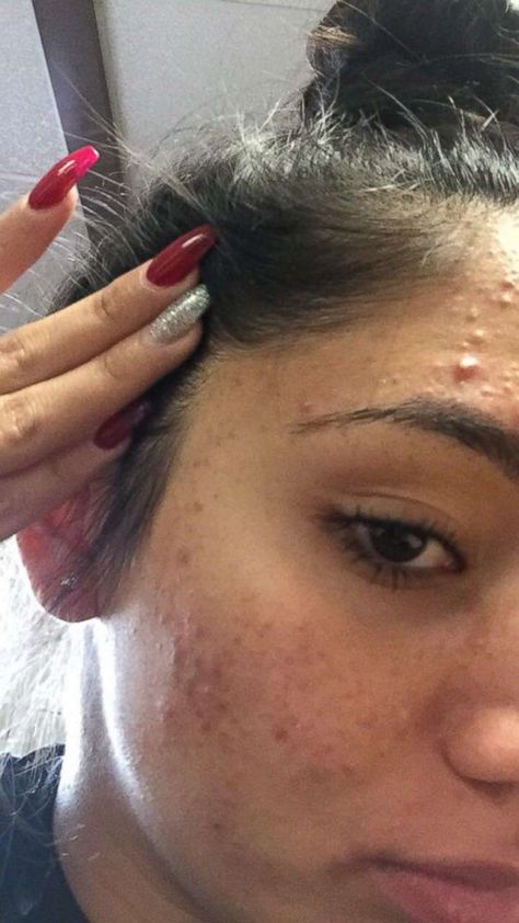 PHOTO: Karina Banuelos, 17, shared this photo of her severe acne before she cleared it up with a skincare routine featuring four cheap products. Acne On Cheeks Meaning, Teen Acne Skincare Routine, Under Skin Acne, How To Clear Up Acne, Makeup For Acne Skin, Makeup On Acne, Mouth Acne, Acne Photos, Acne Face Map