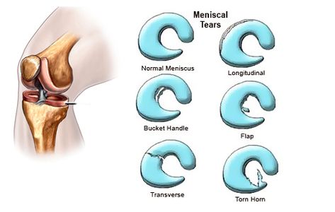 Meniscus Surgery Recovery, Medial Meniscus, Common Knee Injuries, Meniscus Surgery, Parts Of The Knee, Knee Surgery Recovery, Types Of Surgery, Orthopedic Surgery, Knee Exercises