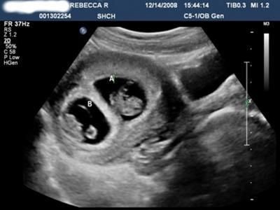 I was about 9 weeks in this ultrasound. I am having a boy and a girl and was completely surprised, yet elated with the news of the twins. 9 Weeks Pregnant Ultrasound, 7 Weeks Pregnant Ultrasound, 9 Week Ultrasound, 7 Week Ultrasound, Twins Ultrasound, 7 Weeks Pregnant, Baby Ultrasound Pictures, 9 Weeks Pregnant, Cute Baby Twins