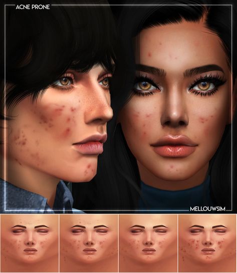 ACNE PRONE MASK | PUBLIC DOWNLOAD | TS4 GET IT ON MY WEBSITE or Ad-free on PATREON x4 Swatches HQ Compatible Found in Skin Details No WCIF Please | Thank you to all the CC creators Any problems don’t... Sims 4 Cc Alien Makeup, Sims Acne, Sims4 Cc Skin, Cc Skin, The Sims 4 Skin, The Sims 4 Pc, Free Sims 4, Skin Details, The Sims 4 Packs