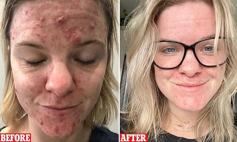 Woman struggling with severe acne reveals how she improved her skin Head Acne, Back Acne, Anti Redness, Severe Acne, Cystic Acne, Remove Acne, Face Sunscreen, Brightening Serum, Natural Face