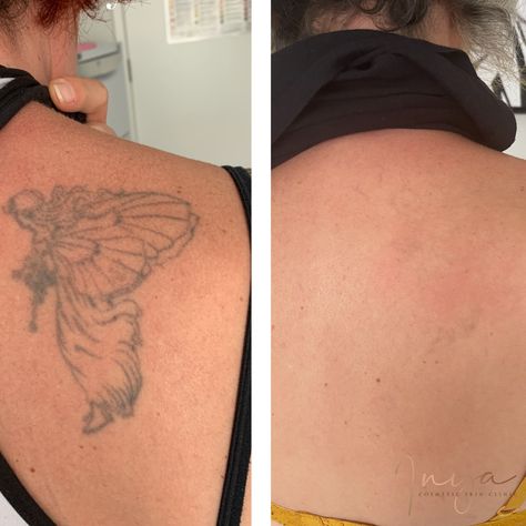 Laser Tattoo Removal Before And After, Tattoo Removal Before And After, Microblading Studio, Tatto Designs, Faded Tattoo, No Regrets Tattoo, Laser Removal, Studio Tattoo, Laser Tattoo