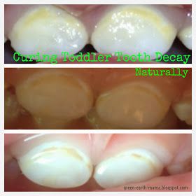 GreenEarthMama: Curing Toddler Tooth Decay Naturally Toddler Cavities, Cavity Remedy, Cavities In Kids, Toddler Tooth Decay, Baby Tooth Decay, Sensitive Teeth Remedy, Dental Decay, Tooth Cavity, Tooth Decay Remedies