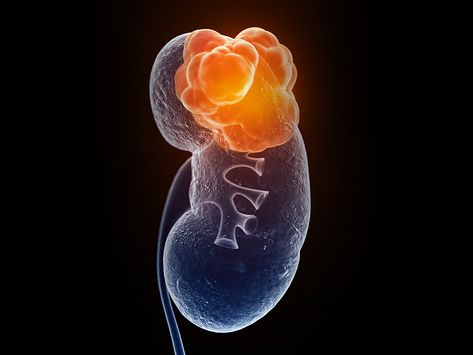 The oral tyrosine kinase inhibitor cabozantinib significantly improved progression-free survival over standard-of-care sunitinib in patients with metastatic renal cell carcinoma. Renal Cell Carcinoma, Beautiful Teeth, Adrenal Glands, Genetic Testing, Genetic, Health Care, Health