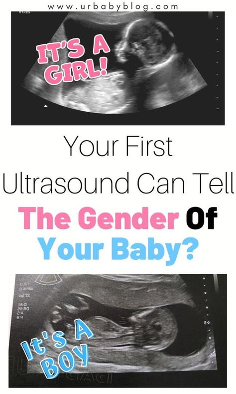 Did you know that your first ultrasound can tell the gender of your unborn baby? Read on to find out how you can know the gender of your baby on the first ultrasound. Sonogram Gender Prediction, Girl Or Boy Predictions, 11 Weeks Pregnant Ultrasound, 10 Week Ultrasound Pictures, Ultrasound Boy Or Girl, Ultrasound Pictures Gender, Boy Ultrasound Pictures, Baby Gender Ultrasound, Ultrasound Gender Prediction