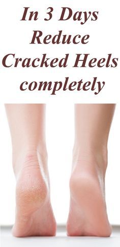 Cracked Heels Diy, Homemade Foot Cream, Cracked Feet Remedies, Nails Remedies, Remedies For Cracked Heels, Heal Cracked Heels, Cracked Heel Remedies, Feet Remedies, Dry Heels