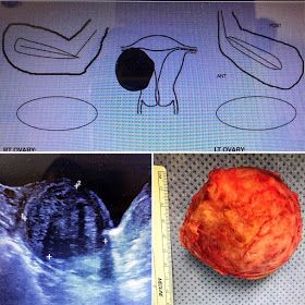 Myomectomy Before And After, Fibroid Surgery, Preparing For Surgery, C Section Recovery, Laparoscopic Surgery, Surgery Recovery, Over 50, Reproductive Health, Abdominal Pain