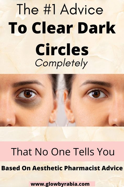 Do you struggle to understand what is causing your under eye dark circles? Have you tried many serums and products for under eye dark circles with little benefit? The key to dark circles treatments is understanding the cause which is explained in this post by a dermatology pharmacist. Under eyes dark circles| Under eye bags| How to get rid of dark circles fast| How to get rid of dark circles overnight| Dark circles remedies| best eye serums for dark circles| dark circles treatments How To Reduce Under Eye Darkness, Under Eye Mask For Dark Circles, Get Rid Of Dark Circles Under Eyes, How To Cover Dark Circles Under Eyes, Dark Circle Remedies Overnight, Eye Circle Remedies, Best Eye Serum, Under Eye Dark Circles, Eye Dark Circles