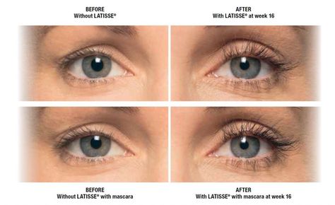 Before and After of Latisse Latisse Eyelashes, Medical Aesthetician, Grow Lashes, Laser Clinics, Eyelash Growth Serum, Eyelash Serum, Eyelash Growth, Natural Eyelashes, Body Sculpting