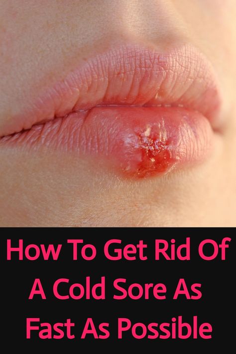 Save this pin to learn how to get rid of a cold sore with remedies and prevention tips from a lifelong cold sore sufferer! From effective treatments to practical prevention strategies, discover the best ways to manage and prevent cold sores. Cover Up Cold Sore, Cold Sore Remedy Fast, Cold Sore Remedy Overnight, Cold Sore Essential Oil, Cold Sore Remedies, Cold Sore Lip, Home Remedies For Cold, Cold Sore Prevention, Home Remedies For Fever