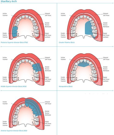 Maxillary Injection Sites Dental Anesthesia Injection Sites, Coronal Polishing Dental, Dental Assistant School, Dental Hygienist School, Injection Sites, Local Anesthesia, Hygiene School, Dental Assistant Study, Dental Hygiene Student