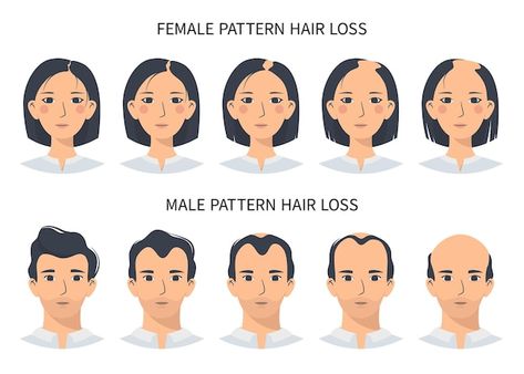 Hair loss stages androgenetic alopecia m... | Premium Vector #Freepik #vector #hair-growth #hair-follicle #hair-loss #human-skin Losing Hair Women, Female Facial Hair, Alopecia Hairstyles, Androgenetic Alopecia, Pattern Baldness, Female Hair, Lost Hair, Male And Female, Facial Hair