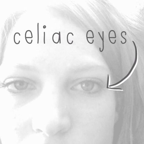 Celiac Eyes, Celiac Awareness, Gluten Free Info, Coeliac Disease, Going Gluten Free, Gluten Free Living, Gluten Sensitivity, Diastasis Recti, Gluten Intolerance