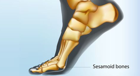 sesamoid bone foot, fracture, treatment, boca raton, florida Sesamoid Bone, Bone Fracture, Some People, How To Know, Bones, Quick Saves